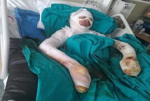 Liseli kz bitlenen salarn benzinle ykamak isterken kendini yakt