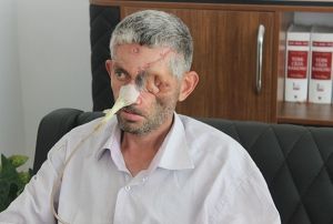 Diini ektirdi, gzn kaybetti