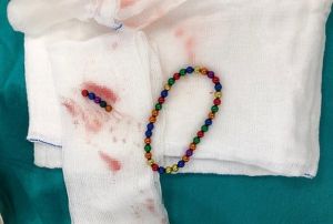 Hastaneye giden ocuun midesinden 42 adet mknats topu kt