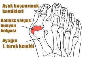 Dar ve sivri burunlu ayakkablar ekil bozukluuna sebep oluyor