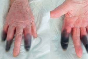 Koronavirs hastas kadn kangren oldu, 3 parma kesildi
