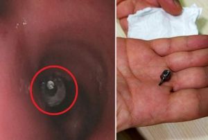 Diide akcierine implant paras kat 