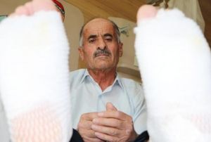 Elektrik akmna kaplnca ayak tabanlar patlad