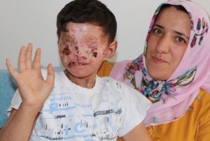 Gzleri kapanan cilt kanseri Salih'ten sevindirici haber