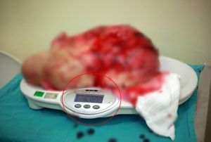 Kadn hastann karnndan 16,9 kiloluk dev kitle kt, 40 yllk dokto