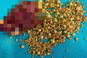 76 yandaki hastann safra kesesinden bin 284 ta kt