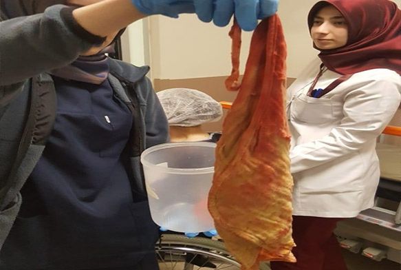 Hastann karnnda havlu byklnde sarg bezi unutmular