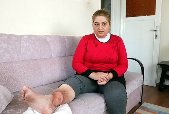Bacaklarnn kesilmemesi iin 60 bin TLye ihtiyac var