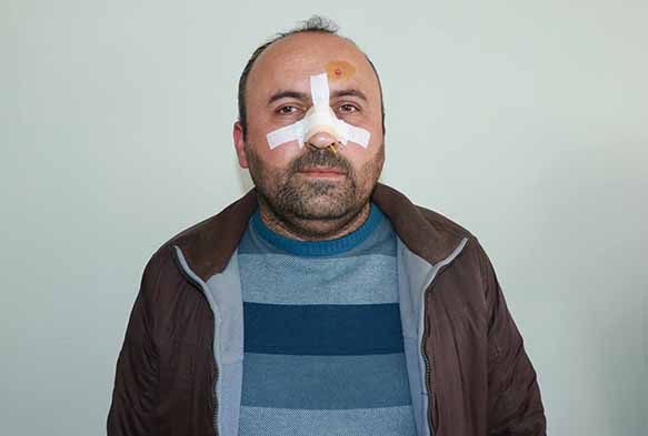 Ekmek kavgasında burnu kırıldı