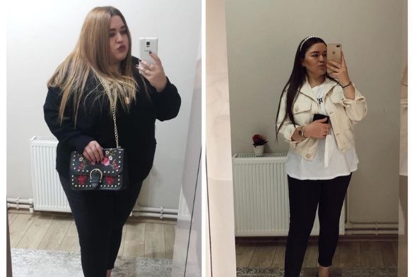 Mide kltme ameliyat ile 9 ayda 58 kilo verdi