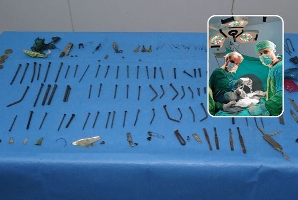 Midesinden 158 parça metal çıktı