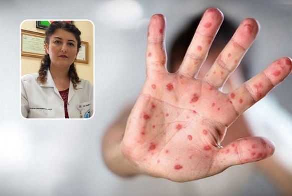 iek as, maymun ieine kar yzde 85 koruyor